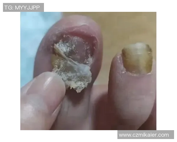 踢足球时如何预防和治疗灰指甲的有效方法与注意事项 踢足球时如何预防和治疗灰指甲的有效方法与注意事项